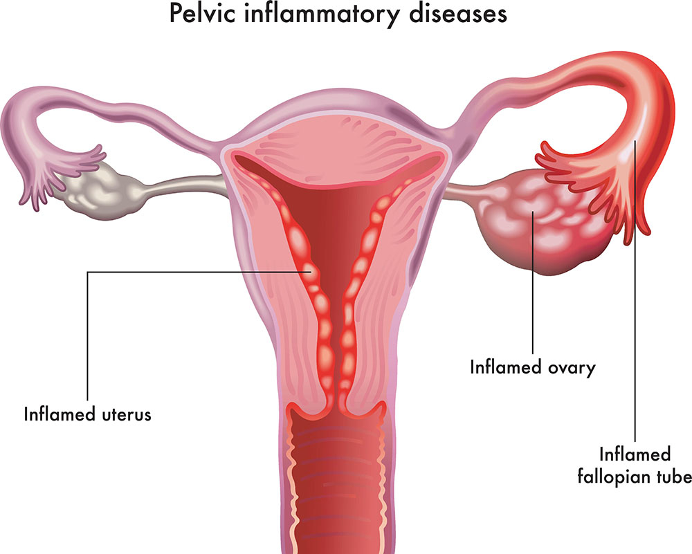 What is Pelvic Inflammatory Disease (PID)